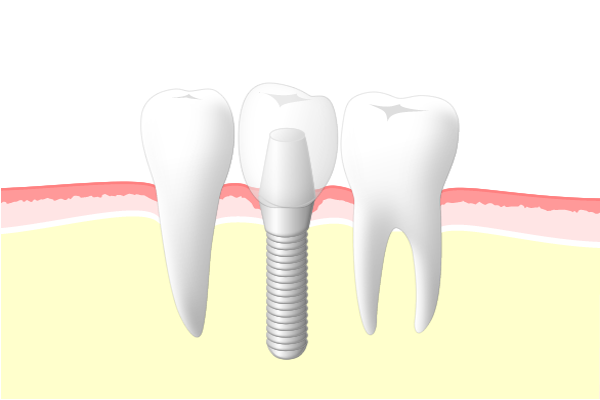 インプラント